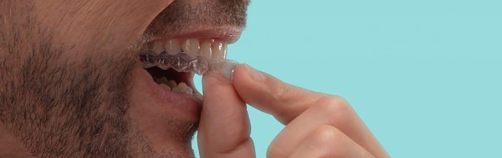 Tratamento com alinhador ortodôntico invisível - Clínica Oral Premium